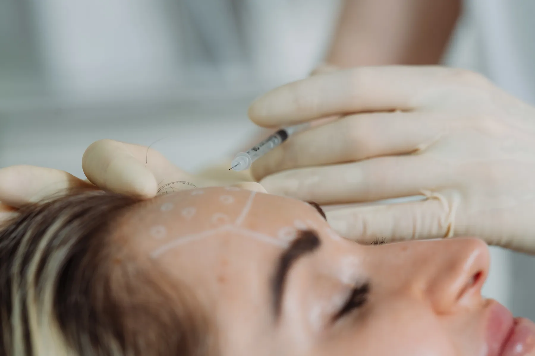 Botulinumtoxin Behandlung in Winterthur